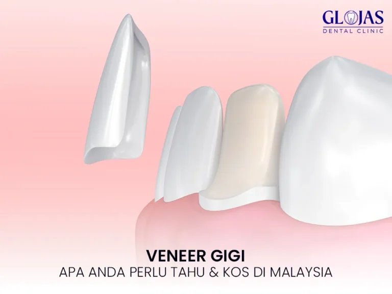 veneer-gigi-klinik-kesihatan-kl-dental