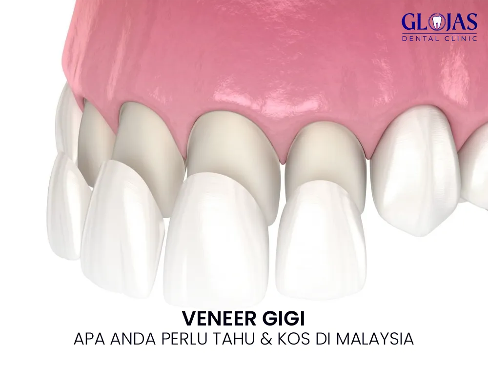 veneer-gigi-klinik-kesihatan-kl-dental