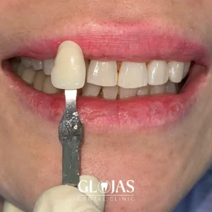 dental-kl-malaysia-whitening