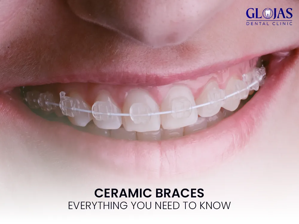 braces-ceramic 