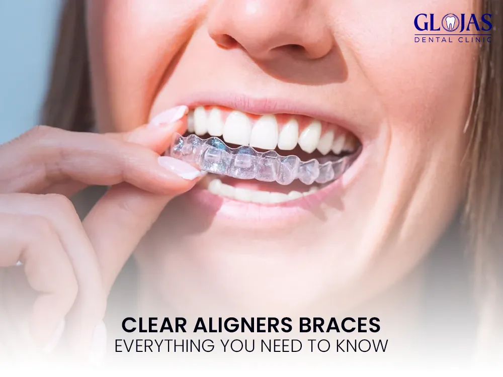 braces-clear-aligner