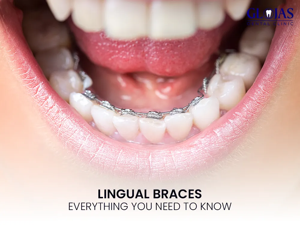 braces-lingual