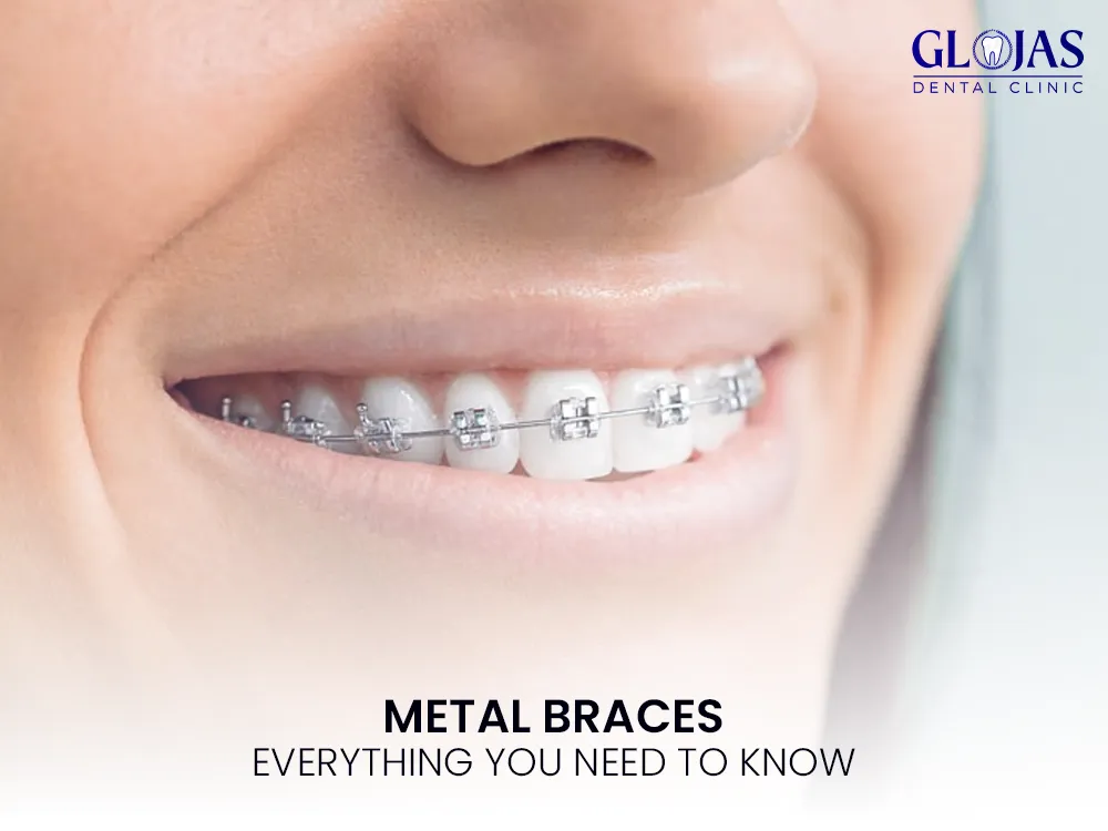 braces-metal