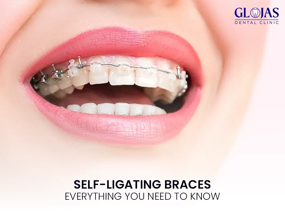 braces-self-ligating