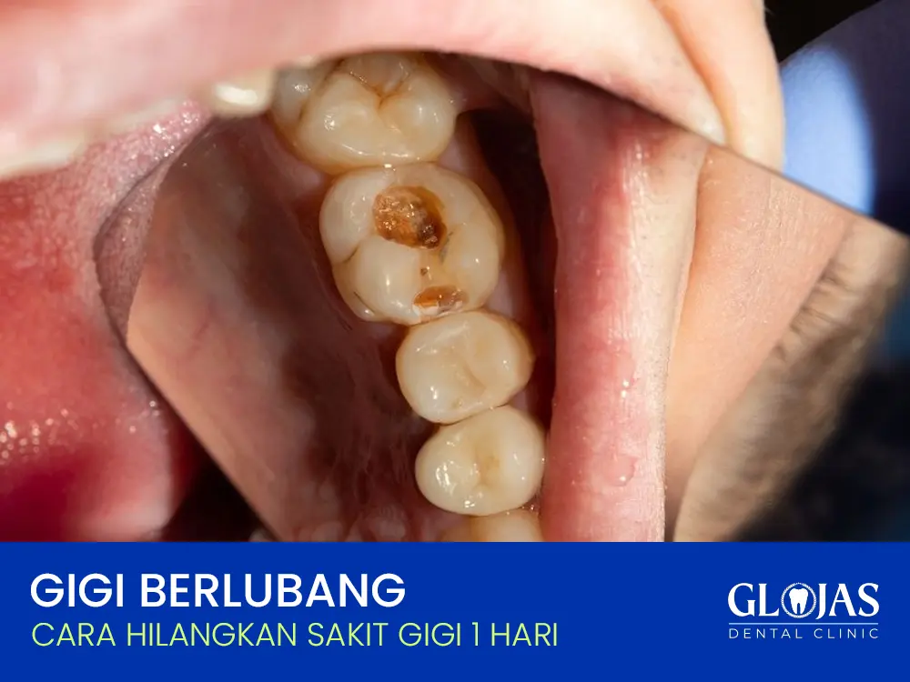 gigi-berlubang-cara-hilangkan-sakit