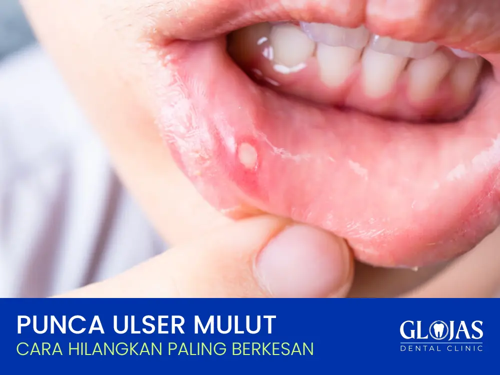 punca-ulser-mulut-cara-atasi-berkesan