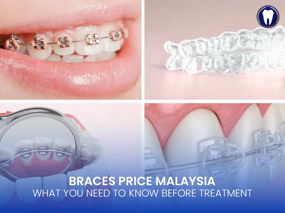 Braces Price Malaysia: What You Need to Know Before Starting Treatment 9 braces-price-malaysia