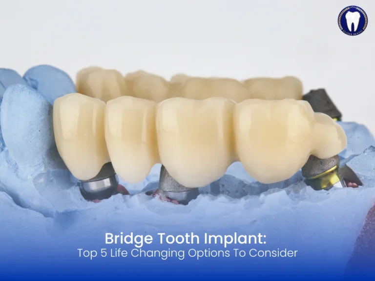 bridge-tooth-implant