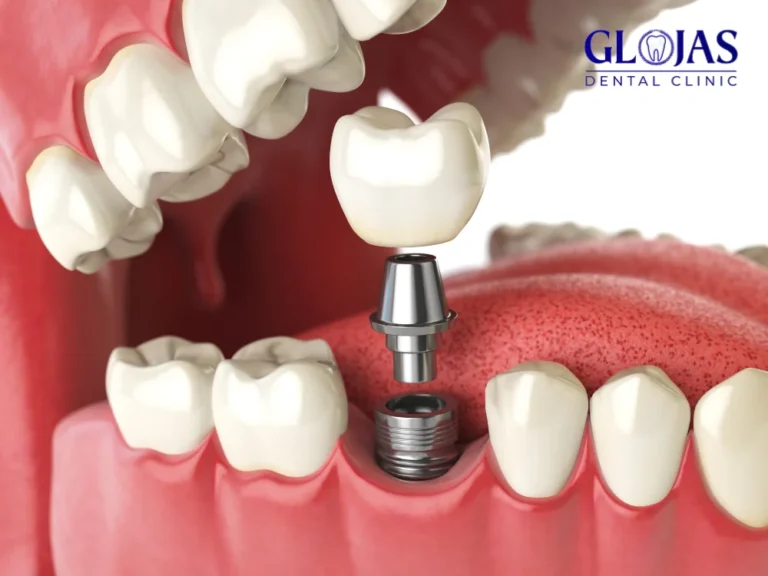 dental-implants-and-dentures