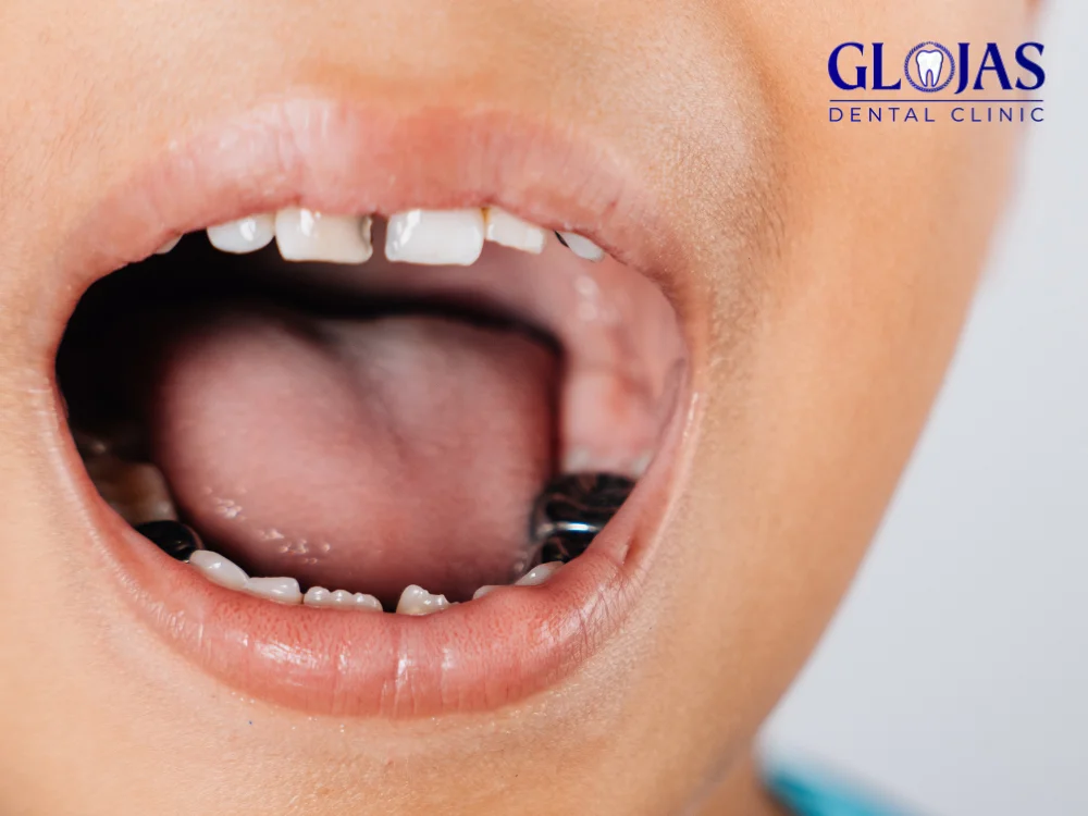 5 Powerful Reasons Why Dental Sealants for Adults Are a Smart Choice! 21 dental-sealants-for-adults