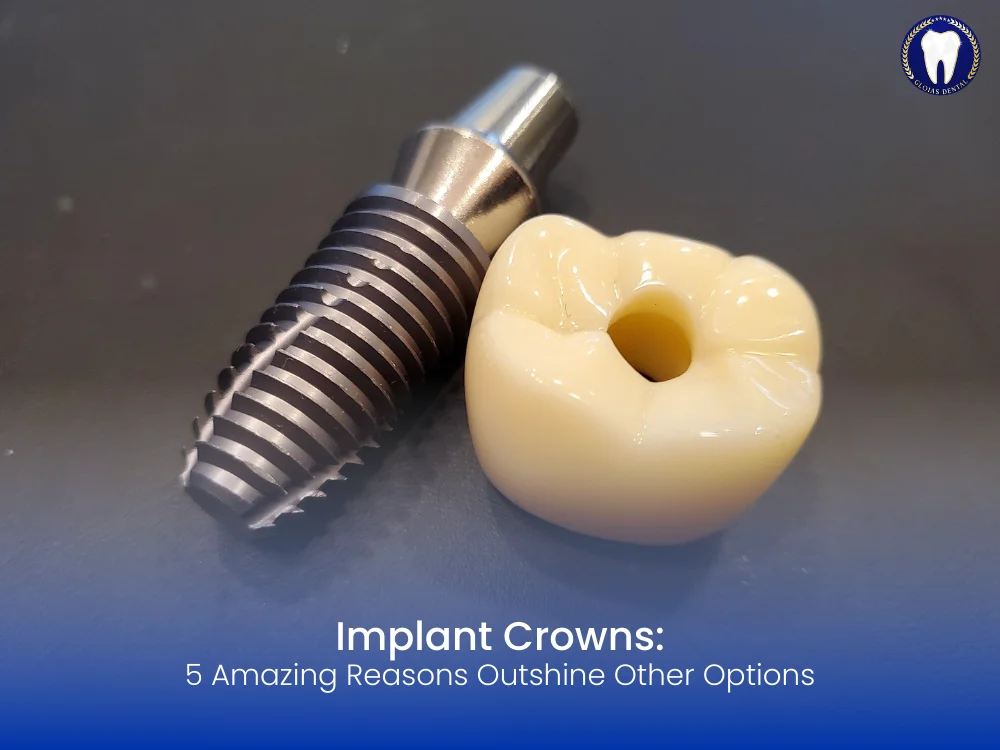 implant-crowns