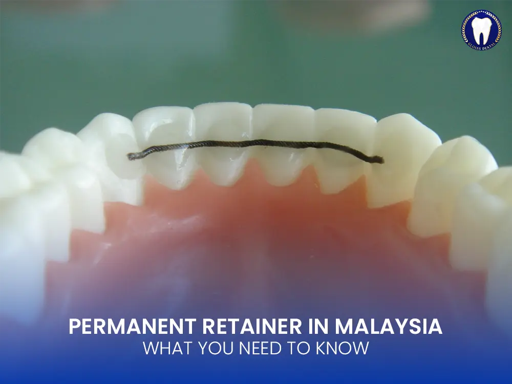 Permanent Retainer in Malaysia: What You Need to Know for Long-Term Smile Protection 17 permanent-retainer-malaysia