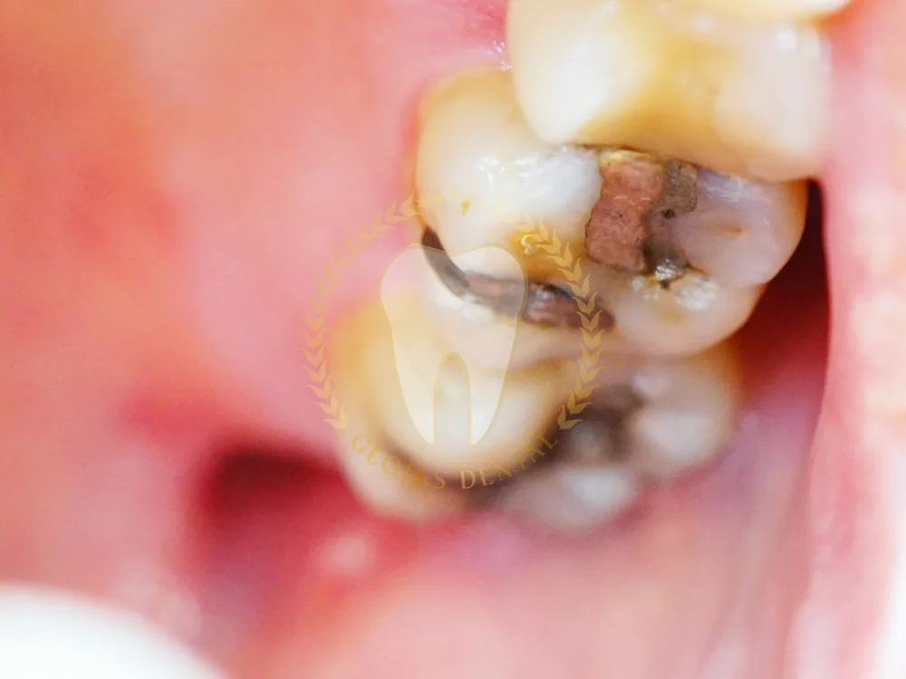 permanent-tooth-filling