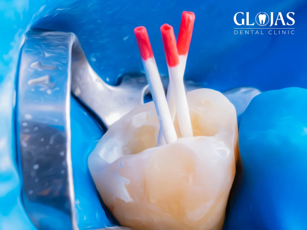 5 Powerful Reasons Why RC Treatment Can Save Your Tooth! 3 rc-treatment