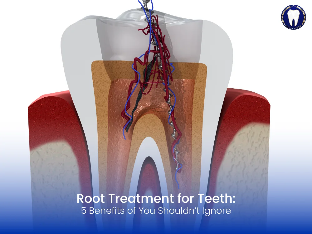 root-treatment-for-teeth