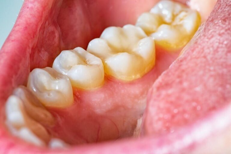 scaling-polishing-dental