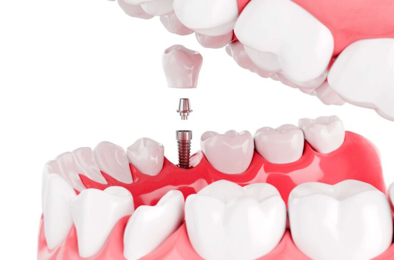 dental-implants-safe-permanent-kuala-lumpur