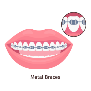 metal-braces-glojas