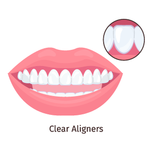 clear-aligners-glojas