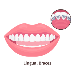 lingual-braces-glojas