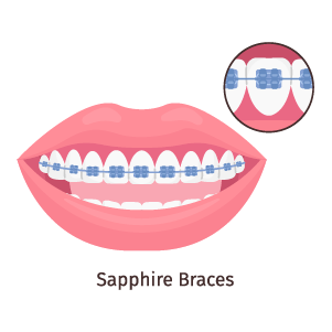 damon-braces-self-ligating-braces