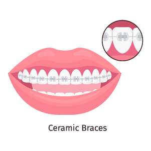 ceramic-braces-glojas