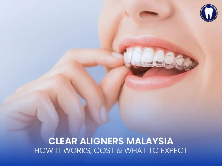 clear-aligners