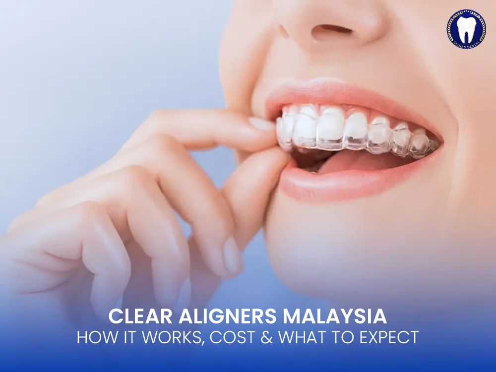 clear-aligners
