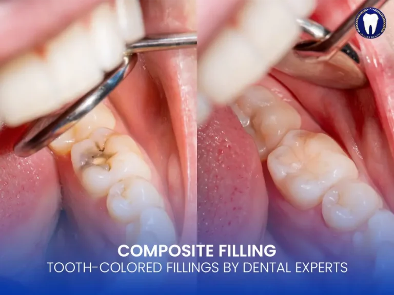 composite-filling-kuala-lumpur