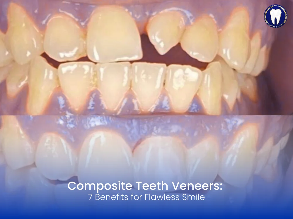 7 Amazing Benefits of Composite Teeth Veneers for Flawless Smiles 7 composite-teeth-veneers