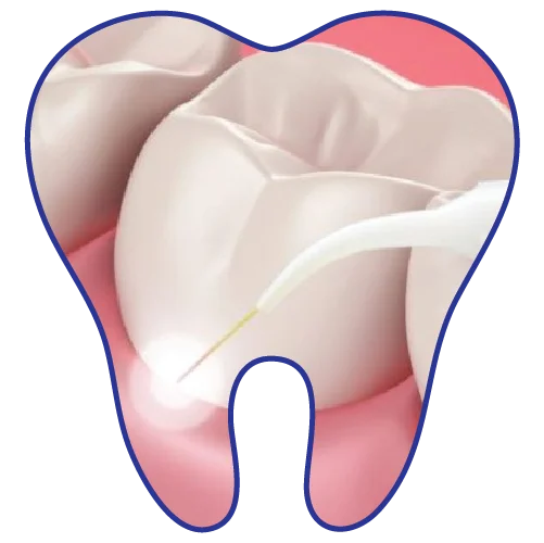 laser-dentistry-dental-clinic-kuala-lumpur-malaysia
