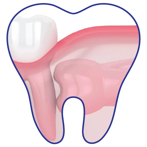 wisdom-tooth-surgery-dental-clinic-kuala-lumpur-malaysia