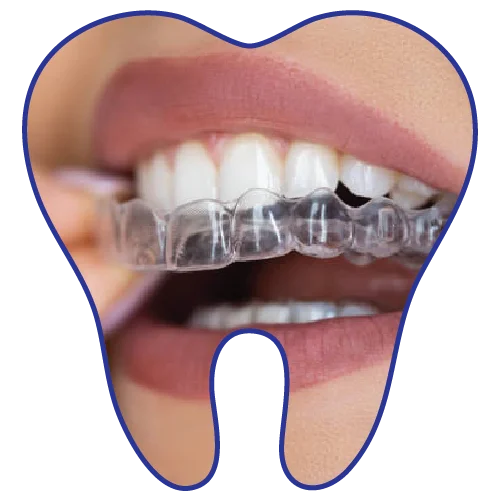 Invisalign-dental-clinic-kuala-lumpur-malaysia