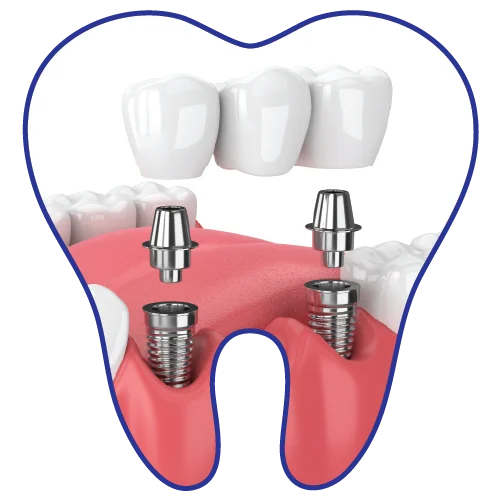 Dental-Implants-dental-clinic-kuala-lumpur-malaysia