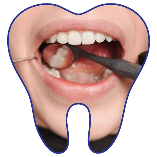 scaling-polishing-dental-clinic-kuala-lumpur-malaysia