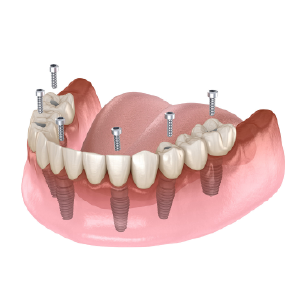 dental-implants-all-on-4-implants