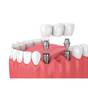 dental-implants-multiple-implants