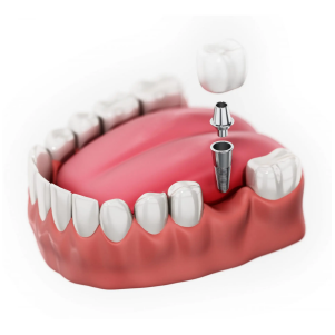 dental-implants-Single-Tooth-Implant