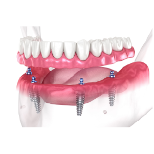dental implants 4