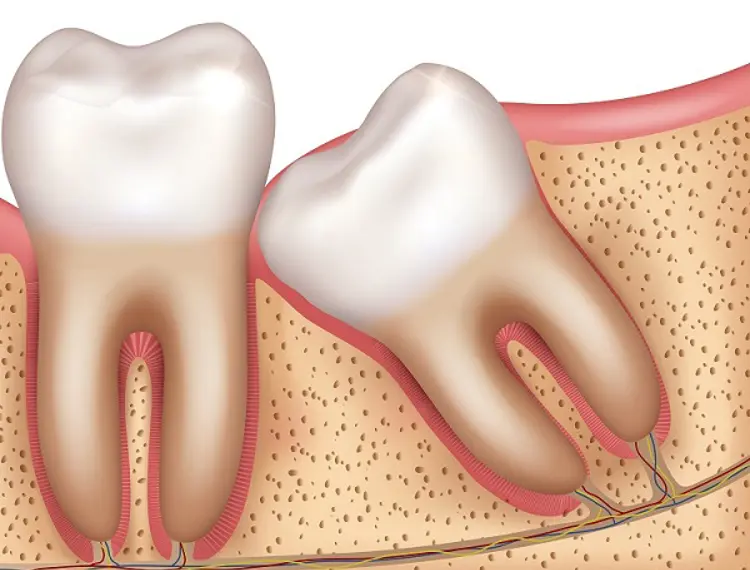 wisdom-tooth-surgery-malaysia