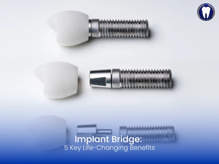 implant-bridge