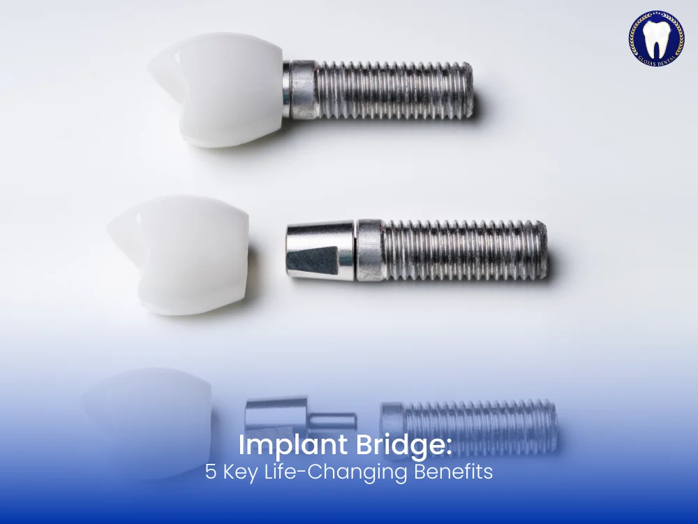 Life-Changing Benefits: 5 Key Reasons to Choose an Implant Bridge 3 implant-bridge