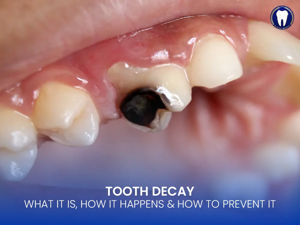 tooth-decay