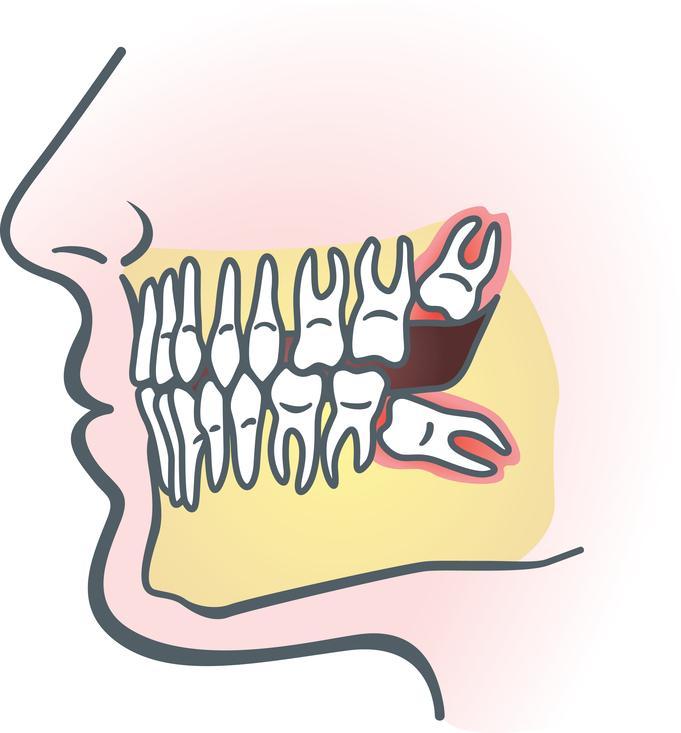 gigi-bongsu-wisdom-tooth