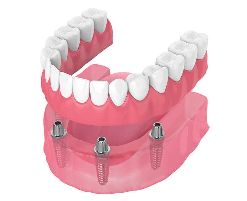 gigi-palsu-implant-detures