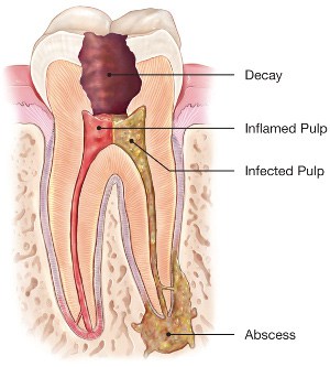 Infected tooth