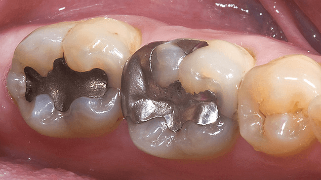 amalgam-filling-tampal-gigi