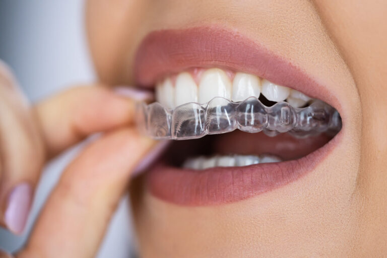clear-aligners-transparent-braces-kuala-lumpur