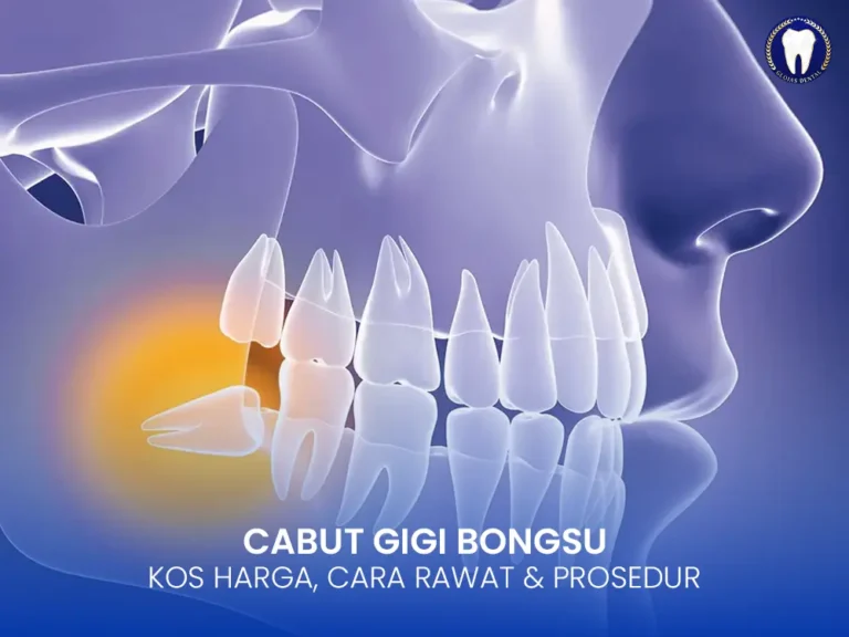 cabut-gigi-bongsu