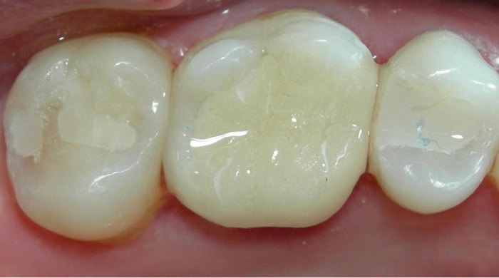 composite-filling-tampal-gigi